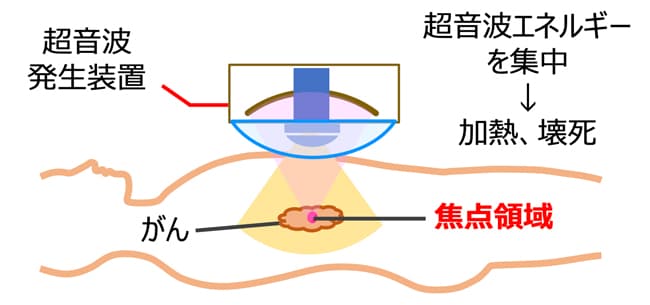 HIFU治療のイメージ